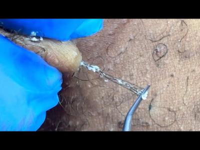 LONG INGROWN HAIR  Endometriosis Isnt Just Period Pain TALK