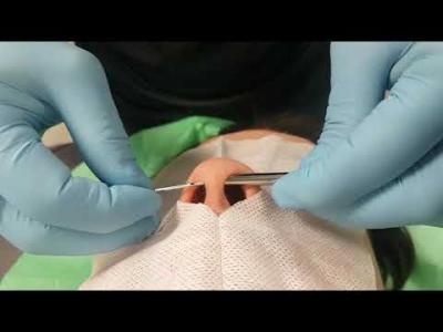 PERFORACIÓN SEPTUM EN NARIZ CON TABIQUE NASAL DESVIADO