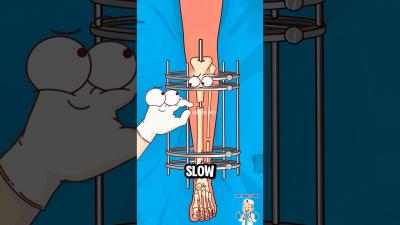 How Leg Lengthening Surgery ACTUALLY Works shorts science